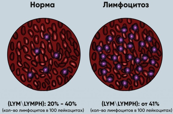 Сыпь у детей лимфоцитоз