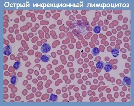 Лимфоцитоз у взрослых. Причины, симптомы, лечение, анализ крови