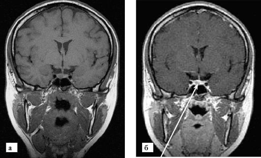 Мрт гипофиза с контрастированием что это такое thumbnail