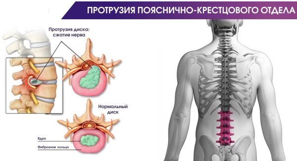 МРТ крестцово-подвздошных сочленений. Что это такое, подготовка