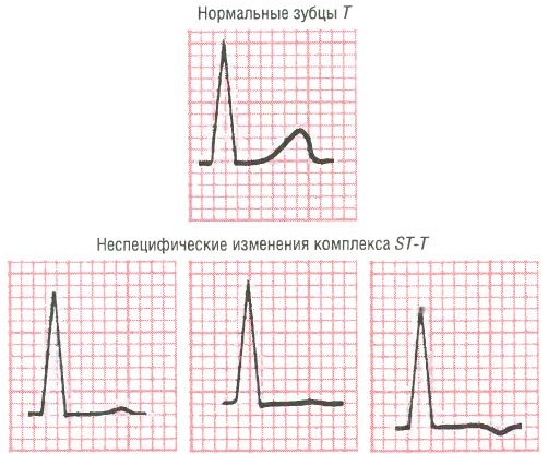 неспецифические нарушения st t элевация что это. Смотреть фото неспецифические нарушения st t элевация что это. Смотреть картинку неспецифические нарушения st t элевация что это. Картинка про неспецифические нарушения st t элевация что это. Фото неспецифические нарушения st t элевация что это