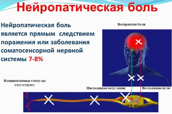 Нейропатические боли. Что это у взрослых, детей, причины возникновения, симптомы, лечение