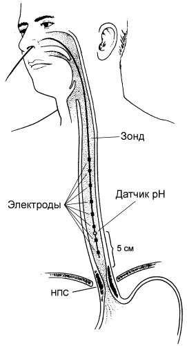 Низкая кислотность желудка. Симптомы, причины, лечение