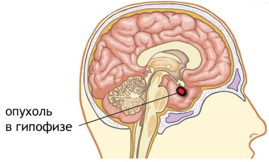 Опухоль гипофиза. Симптомы у женщин, мужчин, ребенка, причины, лечение