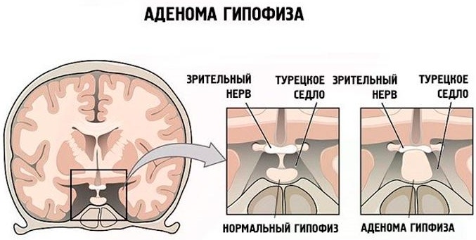 Опухоль гипофиза. Симптомы у женщин, мужчин, ребенка, причины, лечение