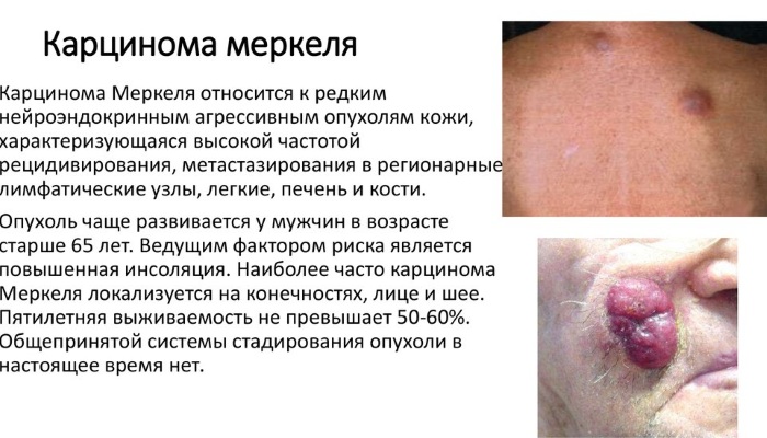 Орфанные заболевания. Что это такое, перечень, классификация, лечение
