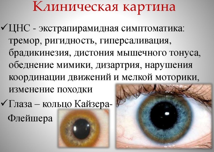 Орфанные заболевания. Что это такое, перечень, классификация, лечение