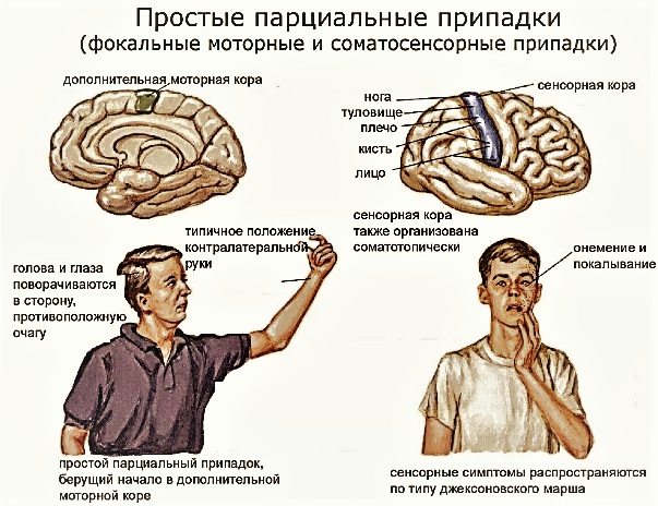 Парциальные судороги. Что это такое, причины, симптомы, лечение