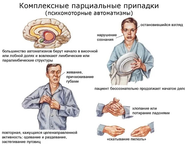 Парциальные судороги. Что это такое, причины, симптомы, лечение