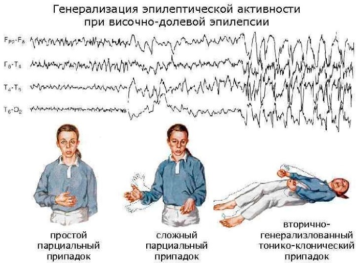 Парциальные судороги. Что это такое, причины, симптомы, лечение