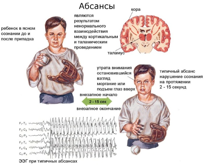 Парциальные судороги. Что это такое, причины, симптомы, лечение