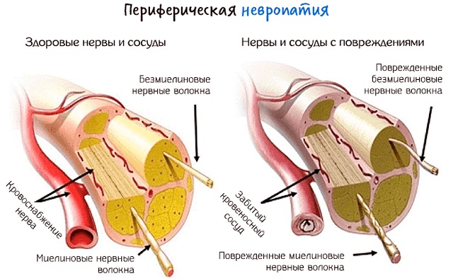 Немеет правая нога ниже колена. Причины, лечение