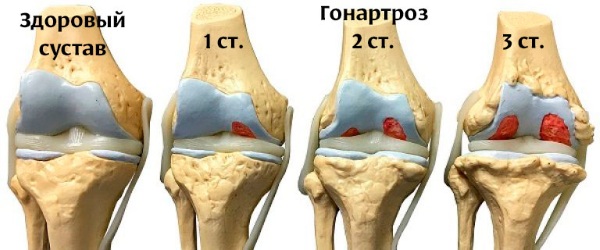 Гонартроз 1 степени фото