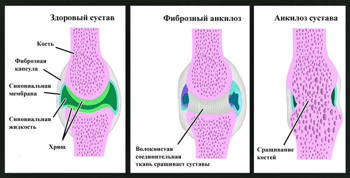 Первичный гонартроз двусторонний коленного сустава. Что это такое, симптомы, лечение