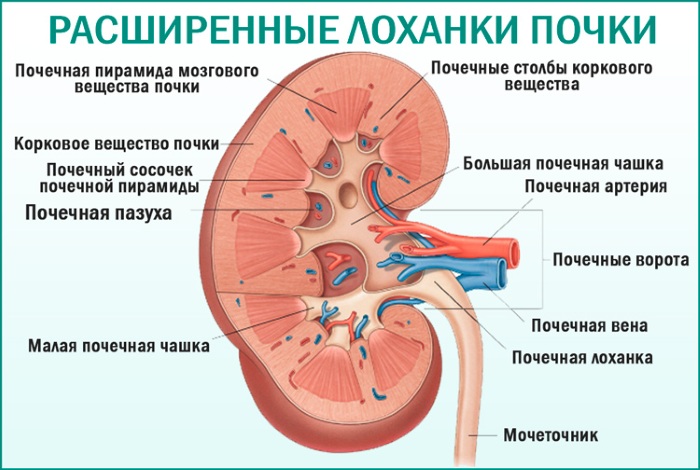 Пиелоэктазия почек у ребенка, взрослых, плода. Что это такое, симптомы, лечение