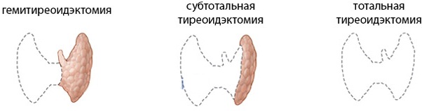 Подострый тиреоидит. Симптомы, лечение, что это такое, клинические рекомендации