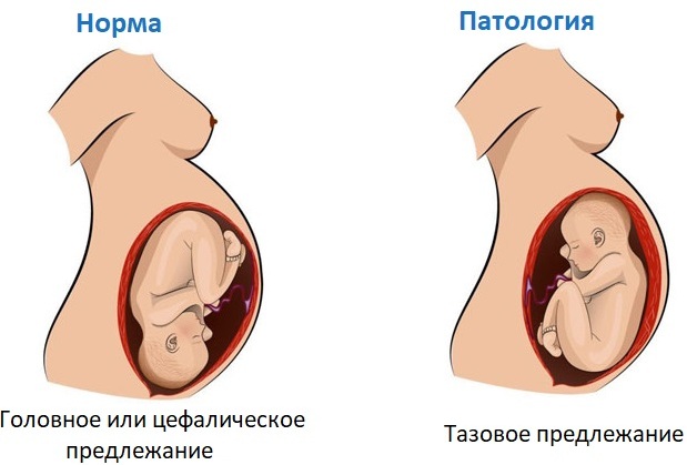 Разрыв промежности 1-2-3-4 степени при родах. Признаки, классификация, как избежать, ушивание, лечение