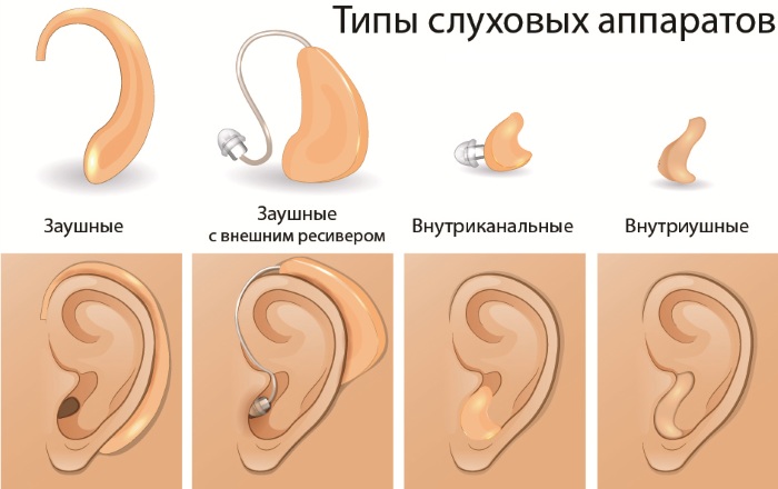 Слуховые аппараты для пожилого человека. Цена, как подобрать, где купить