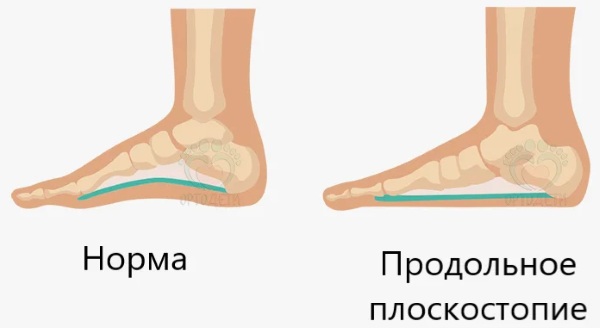 Супинаторы для стопы при плоскостопии. Где купить, как сделать, выбрать, цена, фото