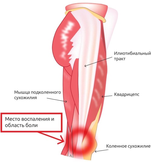 Тейпирование коленного сустава. Схемы при артрозе, растяжении связок, разрыве мениска, виды