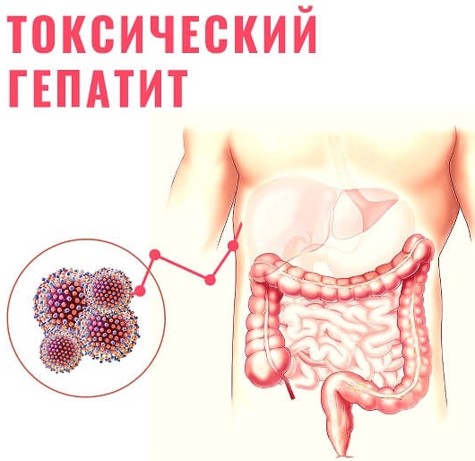 Токсический гепатит. Что это такое, симптомы, лечение, клинические рекомендации