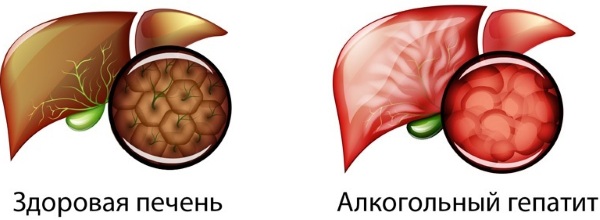 Обесцвеченный кал при гепатите фото