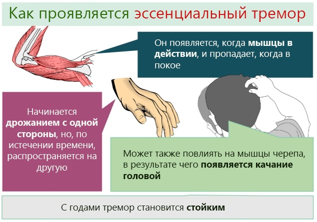 Тремор головы. Причины у взрослых, подростка, грудничка, лечение при волнении, шейном остеохондрозе, неврозе