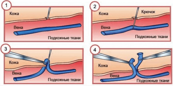 Тяжесть в ногах. Причины у женщин, мужчин ниже, выше колена, лечение, к какому врачу обратиться