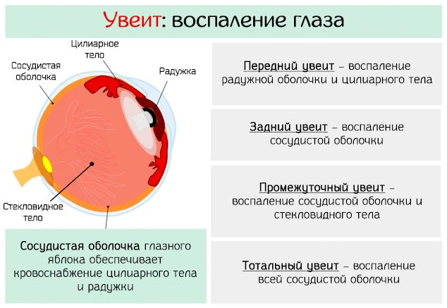 Увеит. Лечение в домашних условиях, причины, классификация