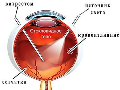 Увеит. Лечение в домашних условиях, причины, классификация