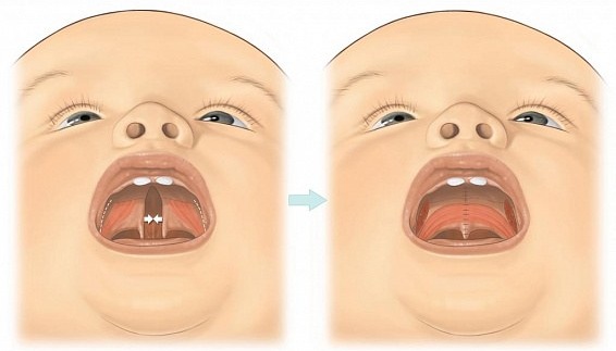 Волчья пасть у детей. Фото до и после операции, причины появления, лечение