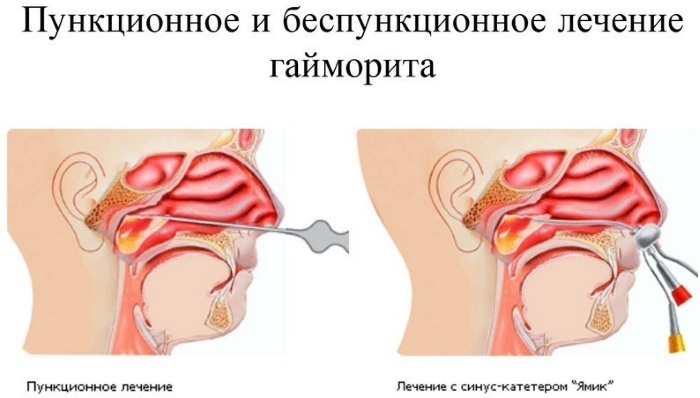 Воспаление пазух носа. Симптомы, лечение у взрослого, ребенка препаратами, народными средствами