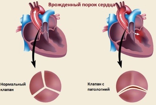 Замедление внутрипредсердной проводимости на ЭКГ. Признаки, причины, лечение