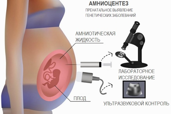 Амниоцентез при беременности. Что это такое, точность, на каком сроке делают, последствия, противопоказания