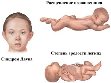 Амниоцентез при беременности. Что это такое, точность, на каком сроке делают, последствия, противопоказания