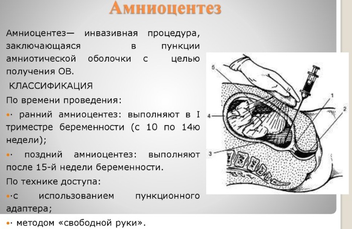 Амниоцентез при беременности. Что это такое, точность, на каком сроке делают, последствия, противопоказания