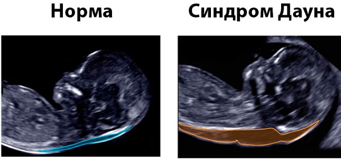 Амниоцентез при беременности. Что это такое, точность, на каком сроке делают, последствия, противопоказания