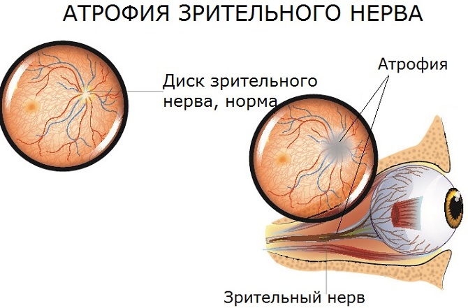 Атрофия зрительного нерва. Что это такое, причины, симптомы, лечение, операция