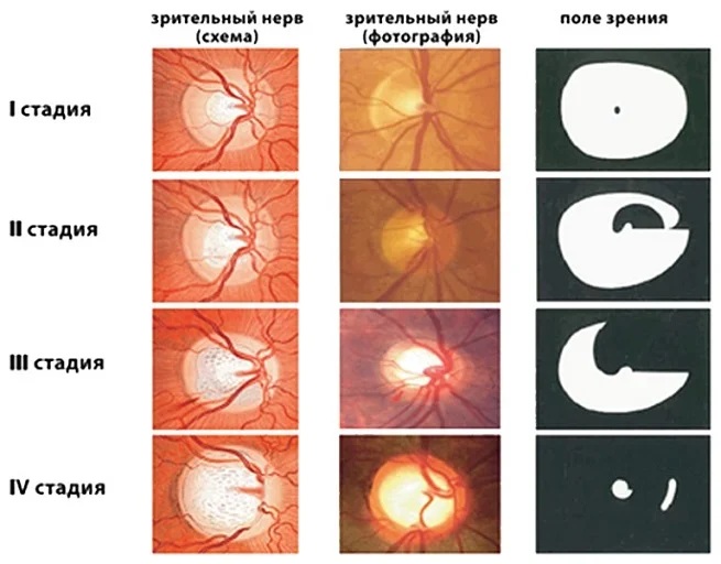 Атрофия зрительного нерва. Что это такое, причины, симптомы, лечение, операция
