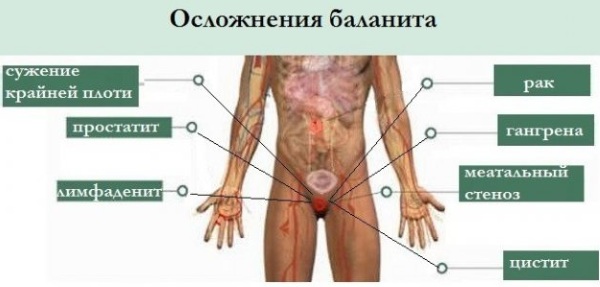 Баланит. Мазь для лечения, народные средства, таблетки, причины, симптомы