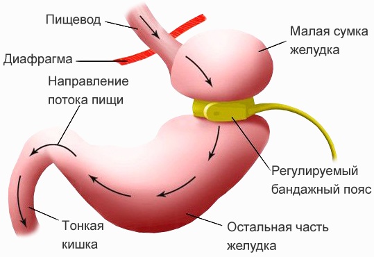 Бариатрическая хирургия. Что это такое, последствия, противопоказания, цена