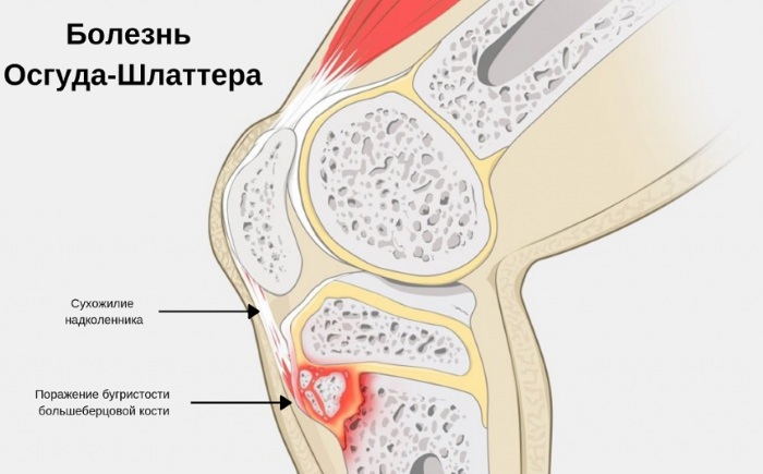 Болезнь Осгуда-Шлаттера. Рентген, стадии, описание, лечение