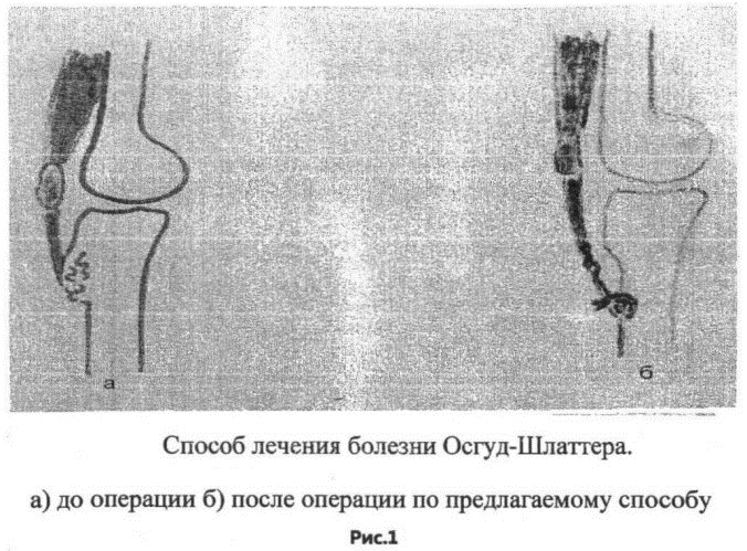 Болезнь Осгуда-Шлаттера. Рентген, стадии, описание, лечение