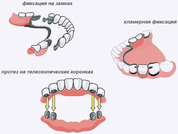 Бюгельные протезы на нижнюю/верхнюю челюсть. Фото на кламмерах, аттачменах, замках, шинирующий, квадротти