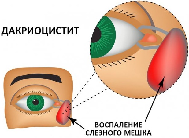 Дакриоцистит у взрослых. Лечение, симптомы, зондирование, способы без операции, антибиотики