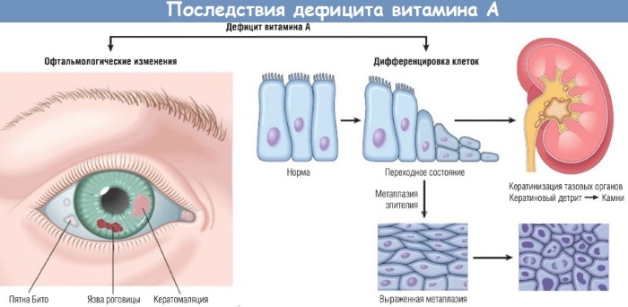 Дефицит витамина А. Симптомы у взрослых, детей, причины, лечение, анализ, диагностика