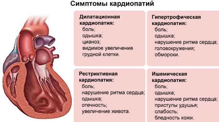 Дилатационная кардиомиопатия фото