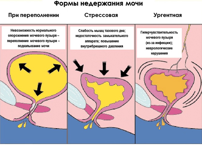 Дизурические расстройства. Что это такое у взрослых, детей, симптомы, виды, лечение при доброкачественной гиперплазии, мочекаменной болезни, остром пиелонефрите