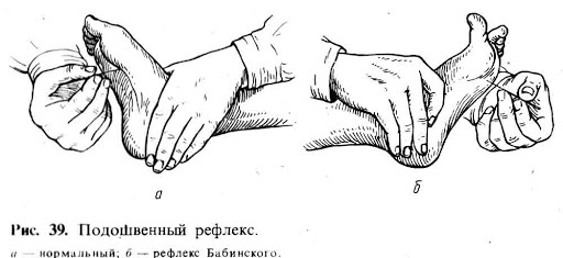 Дыхание Чейна-Стокса. Что это, причины, при каких заболеваниях бывает, как лечить