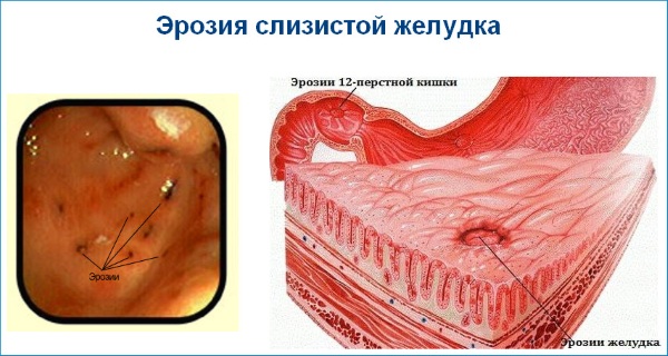 Эрозивный гастрит. Лечение и диета, препараты, народные средства, клинические рекомендации